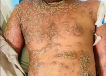 మంకీ పాక్స్‌.. తెలంగాణ ప్రభుత్వం అలర్ట్