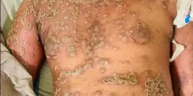 మంకీ పాక్స్‌.. తెలంగాణ ప్రభుత్వం అలర్ట్